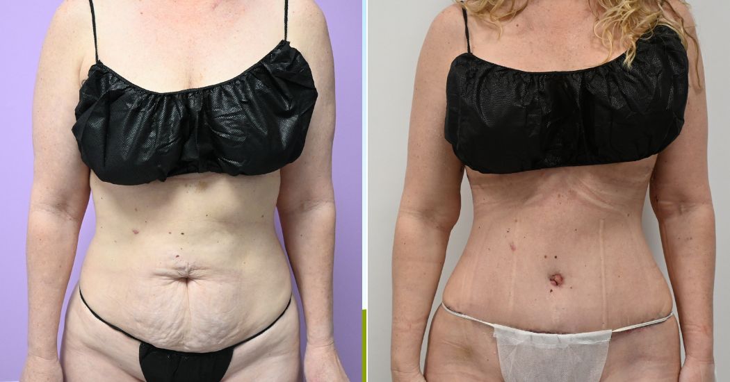 Pre and Post Op Tummy Tuck
