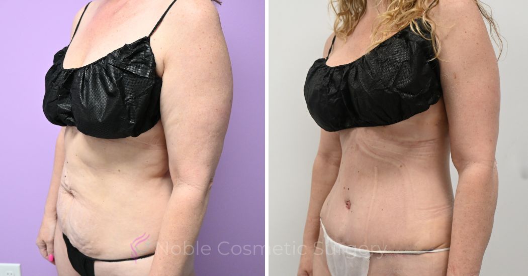 P50--20309A | Before and After Abdominoplasty 2