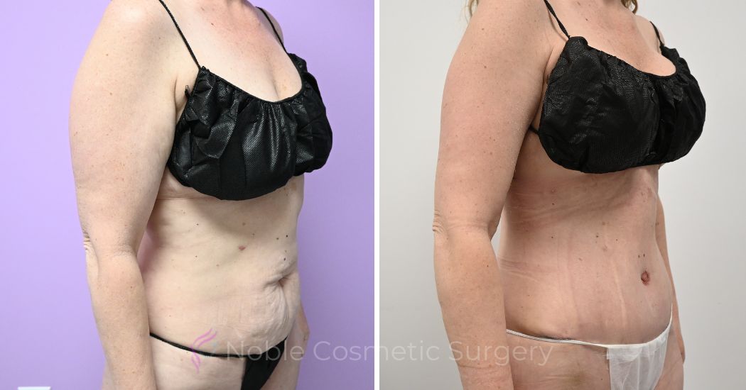 Tummy Tuck 50