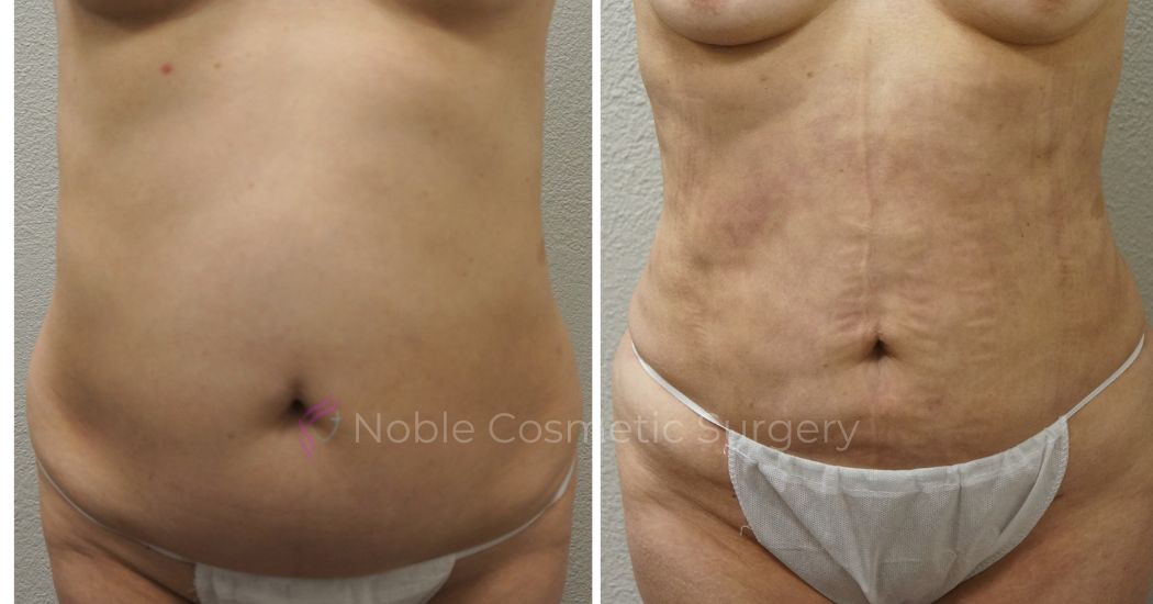Case--2839 | Before and After Liposuction 1