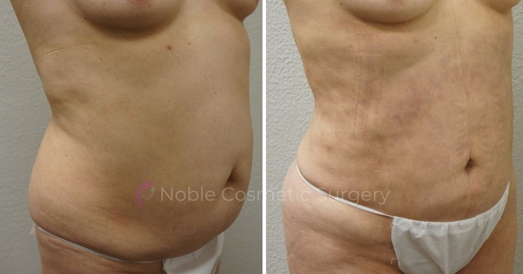 Case--2839 | Before and After Liposuction 2