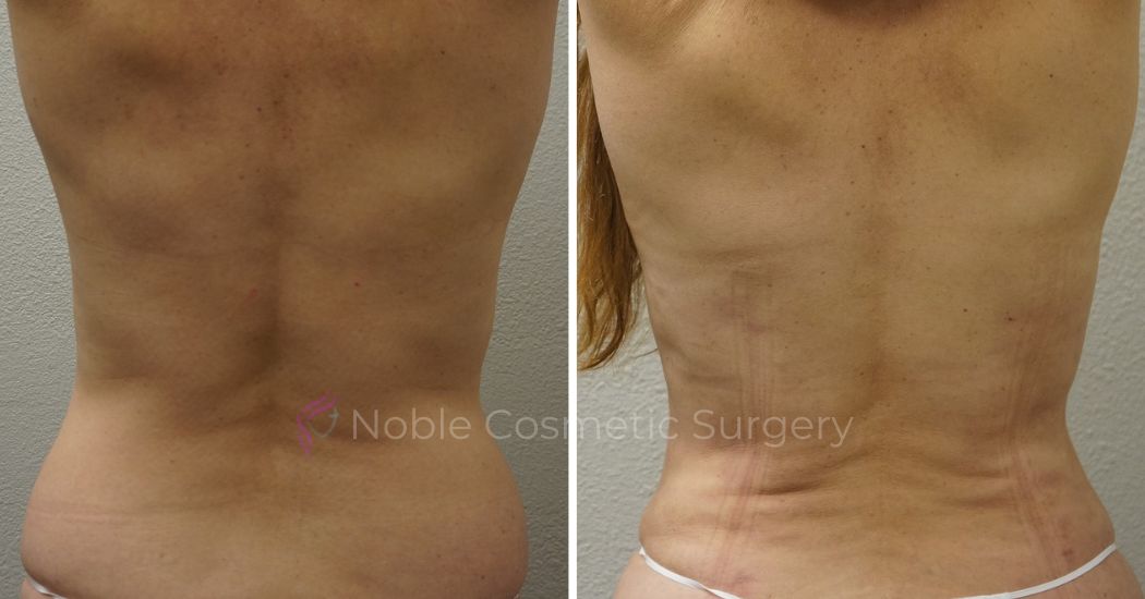 Case--2839 | Before and After Liposuction 3