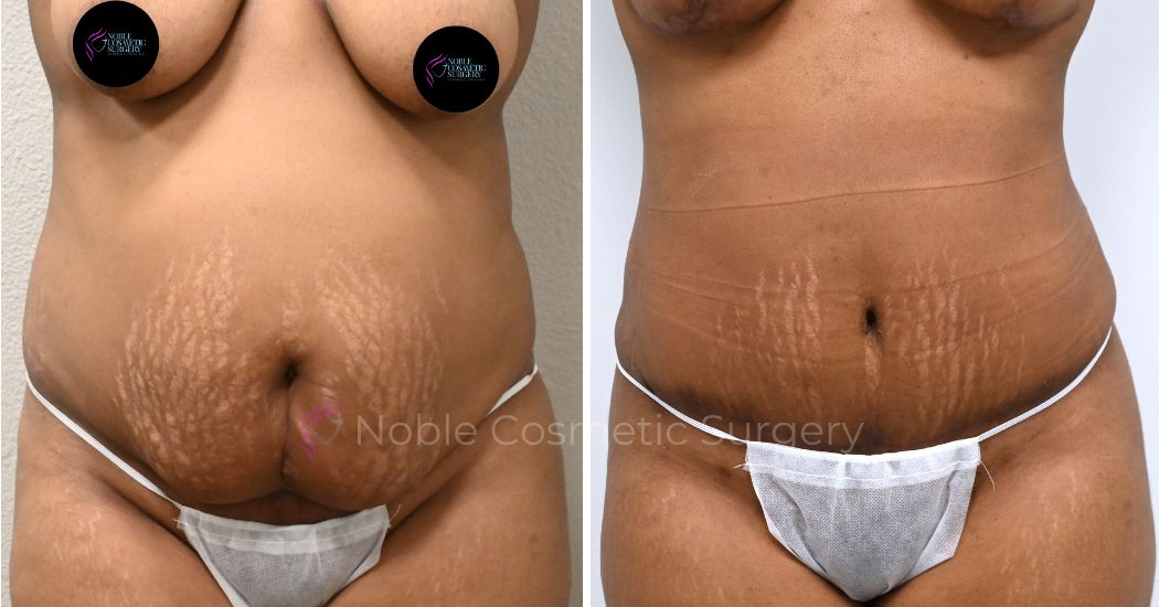 P6-00037A | Before and After Abdominoplasty 1