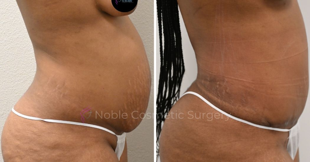 P6-00037A | Before and After Abdominoplasty 2