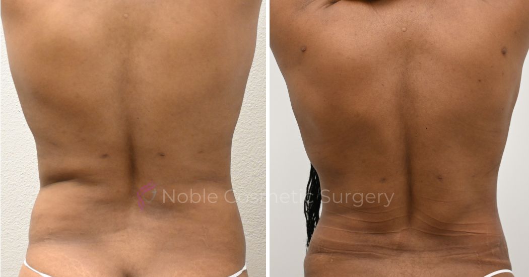 P6-00037A | Before and After Abdominoplasty 3