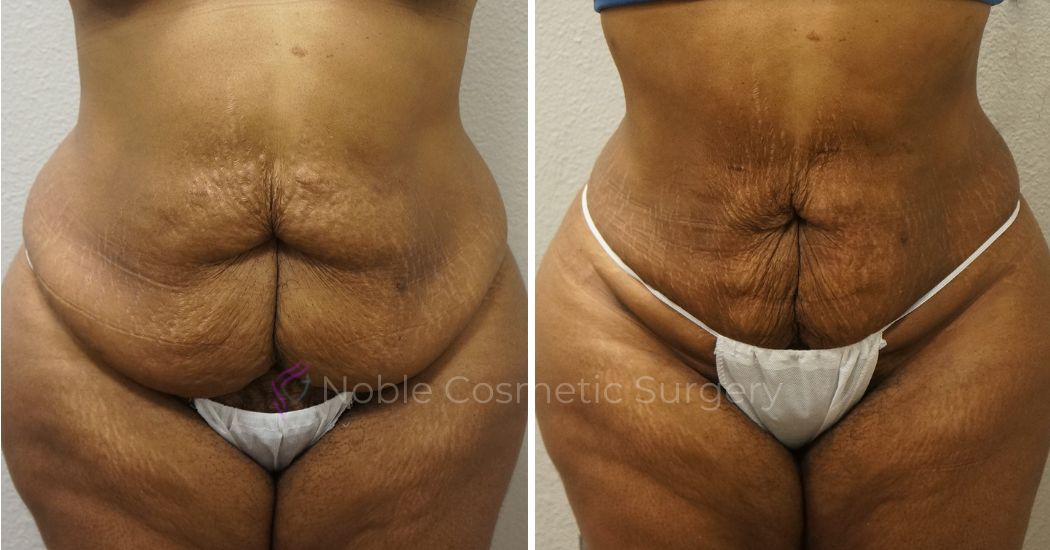 P6-00906L | Before and After Liposuction 1