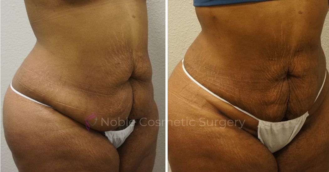 P6-00906L | Before and After Liposuction 2