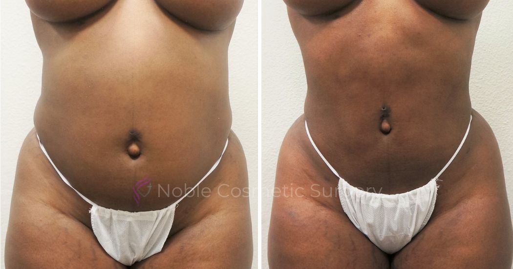 P7-00907L | Before and After Liposuction 1