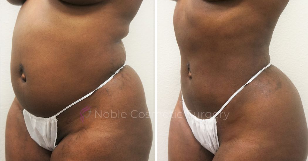 P7-00907L | Before and After Liposuction 2