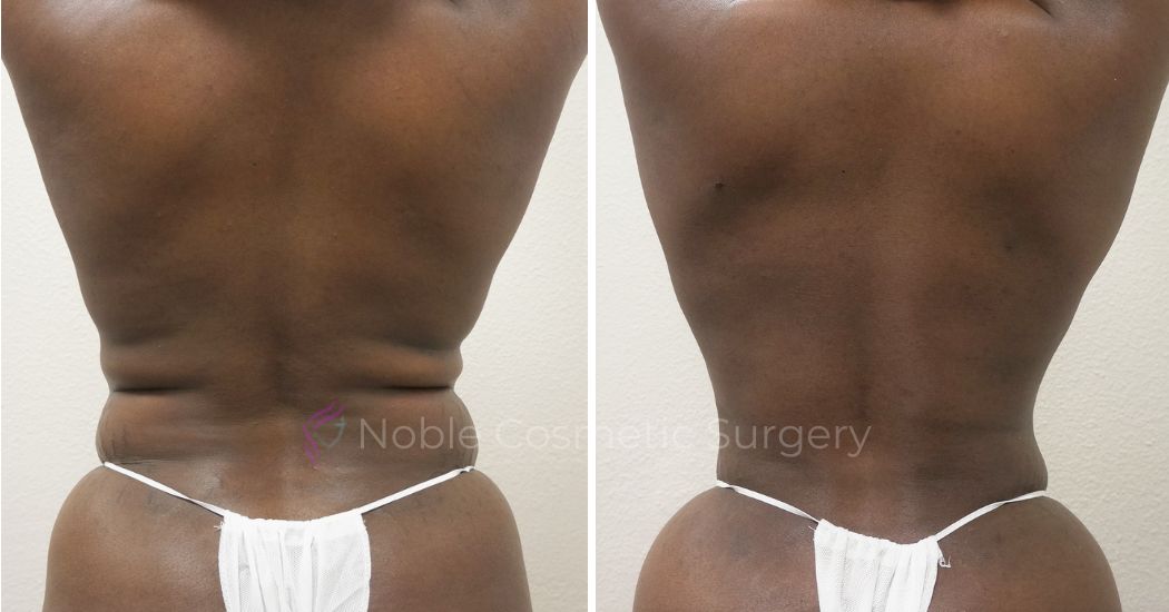 P7-00907L | Before and After Liposuction 3