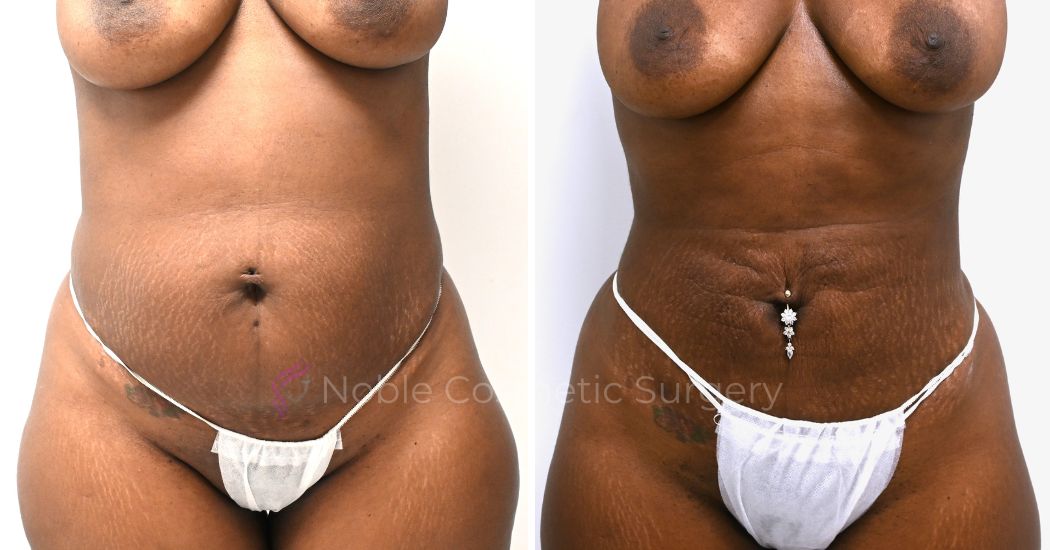 P8-00908L | Before and After Liposuction 1