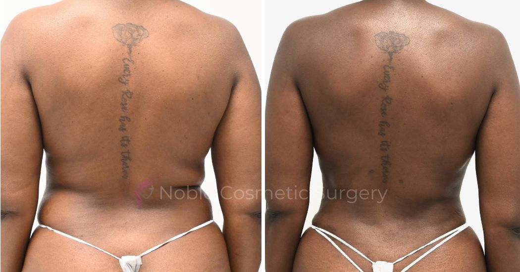 P8-00908L | Before and After Liposuction 2