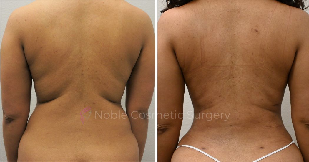 P9-00040A | Before and After Abdominoplasty 3