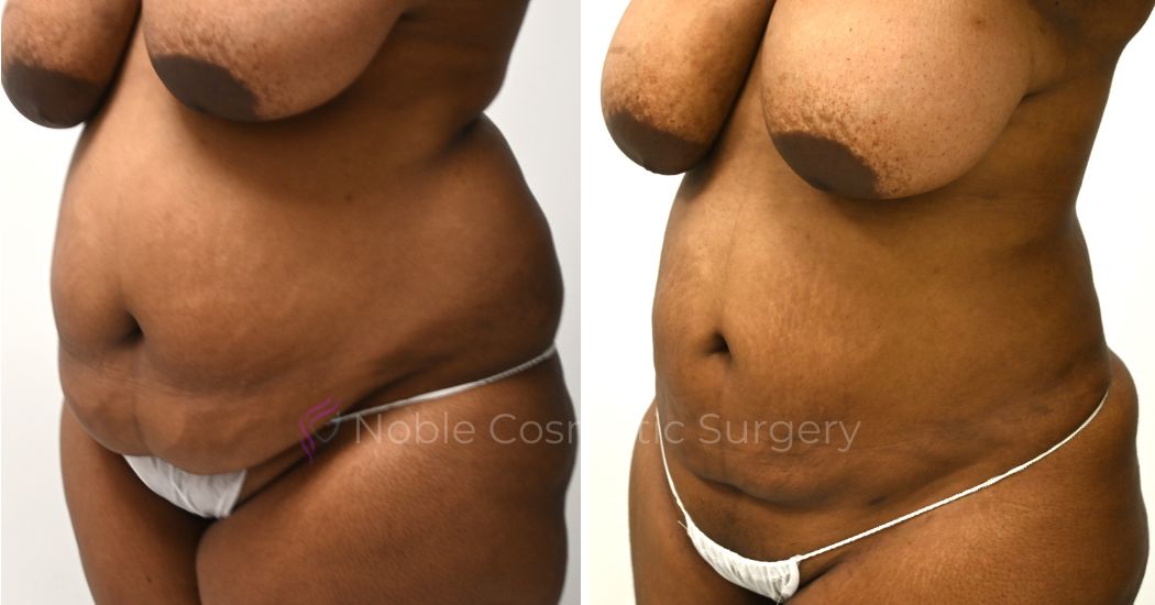 P9-00909L | Before and After Liposuction 1