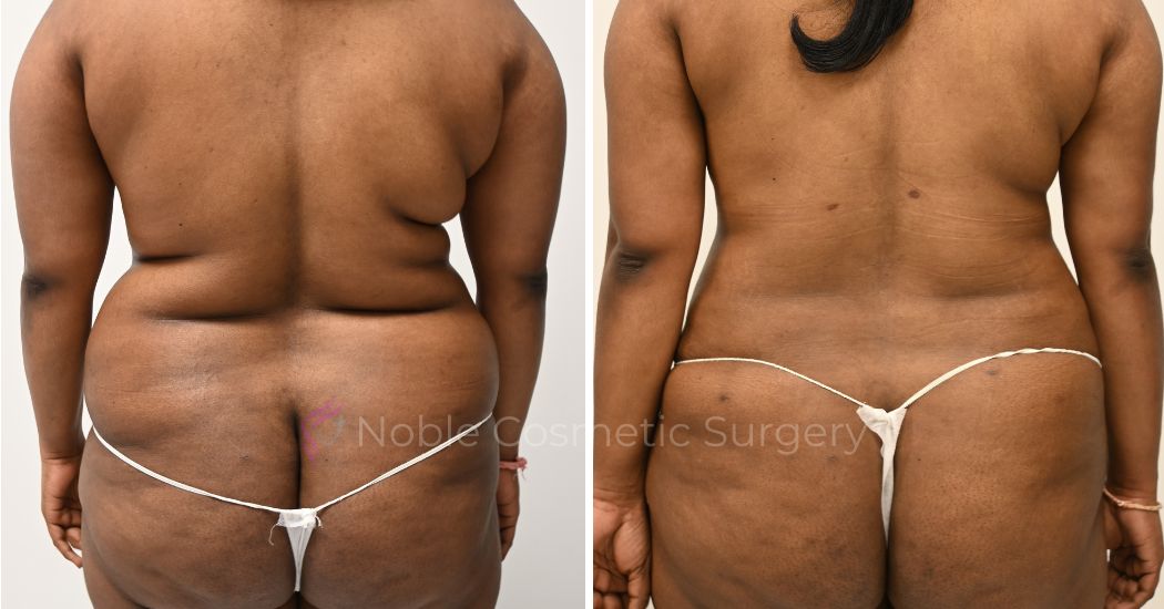 P9-00909L | Before and After Liposuction 3