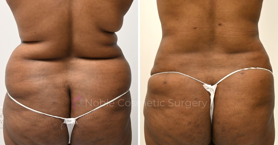 P9-00909L | Before and After Liposuction 2