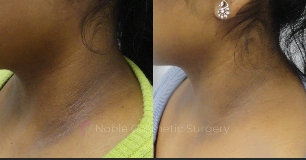 PICO-LASER-CASE-00002 | Before and After Pico Skin Rejuvenation