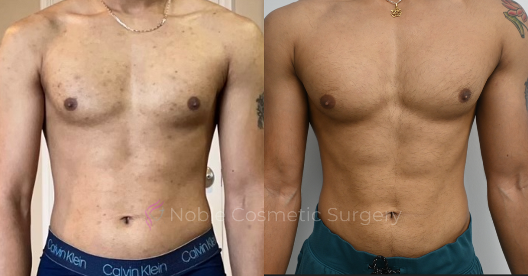 PICO-LASER-CASE-00004 | Before and After Pico Skin Rejuvenation