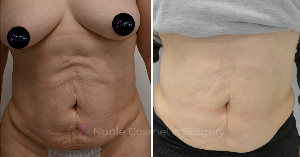 RF-MICRONEEDLING--CASE-00010 | Before and After RF Microneedling