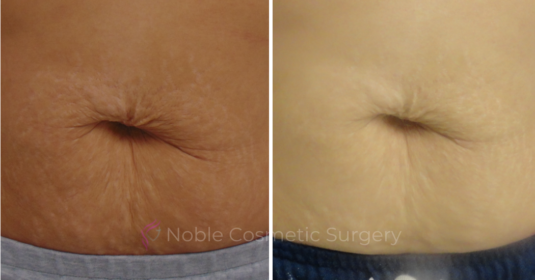 RF-MICRONEEDLING--CASE-00020 | Before and After RF Microneedling