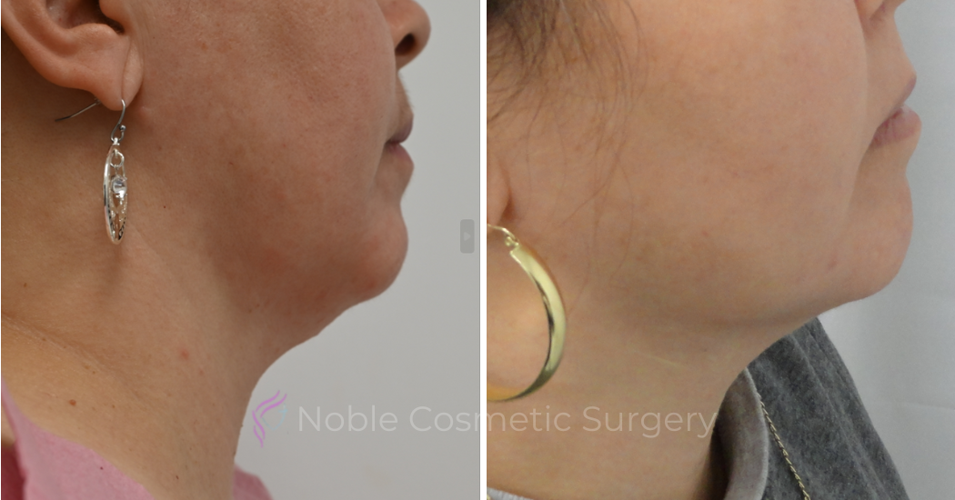 RF-MICRONEEDLING--CASE-00030 | Before and After RF Microneedling