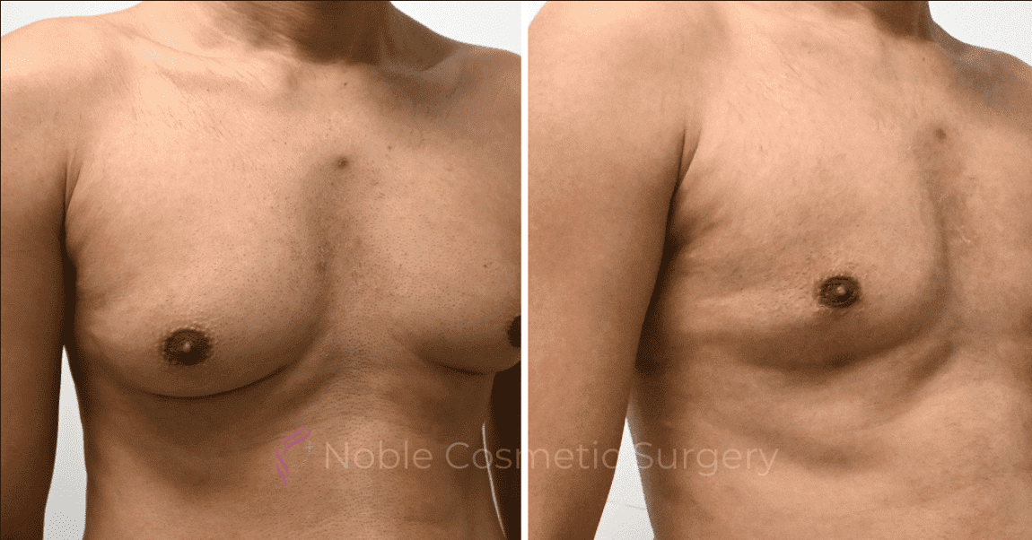 GYNECOMASTIA-CASE-10707 | Before and After Gynecomastia 3