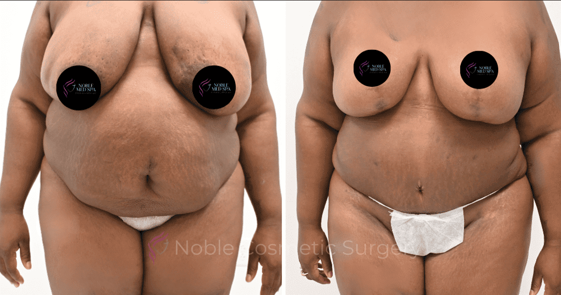 MOMMY-MAKEOVER-CASE-14343 | Before and After Mommy Makeover
