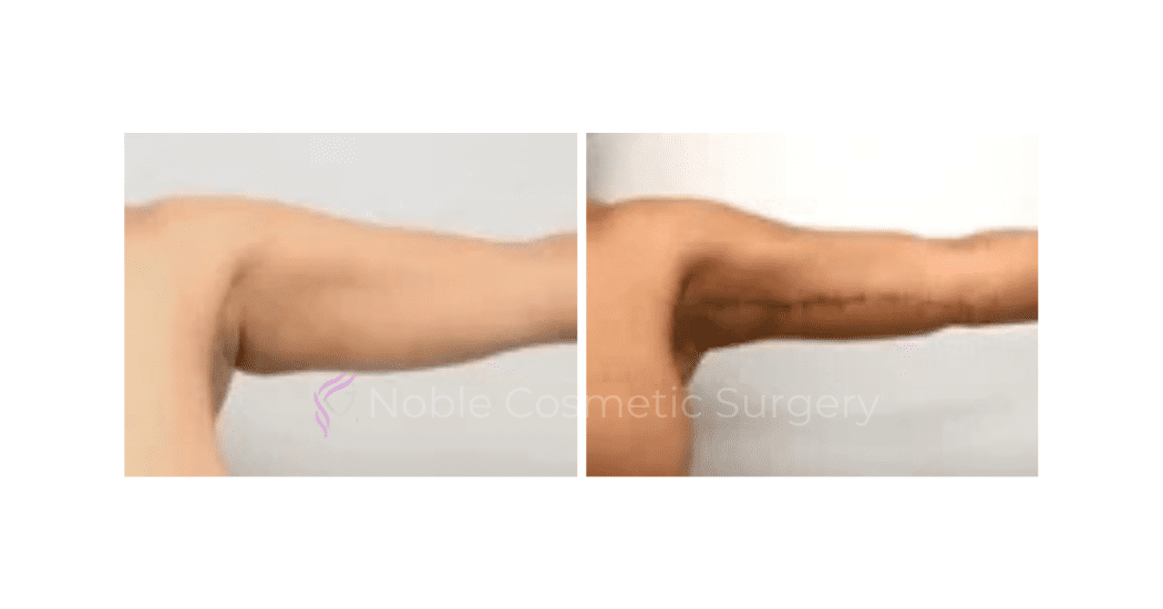 ARM-LIFT-CASE-00251 | Before and After Brachioplasty
