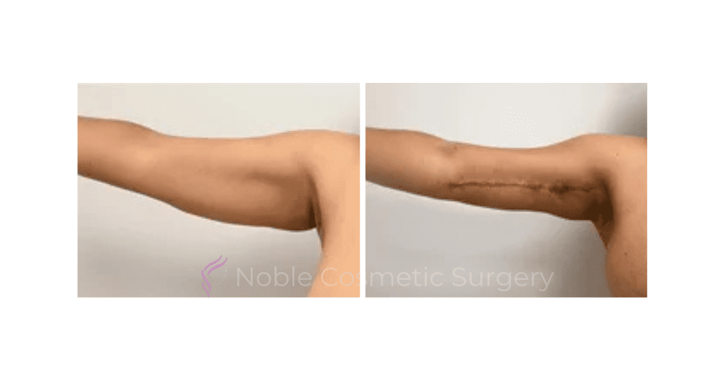ARM-LIFT-CASE-00251 | Before and After Brachioplasty 2