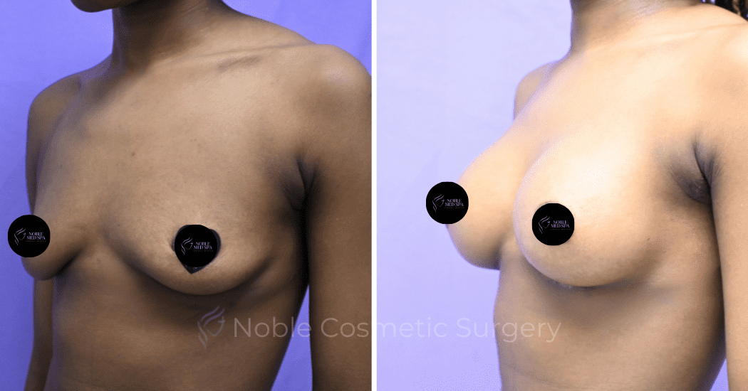 BREAST-AUGMENTATION--CASE-19521 | Before and After Breast Augmentation 3