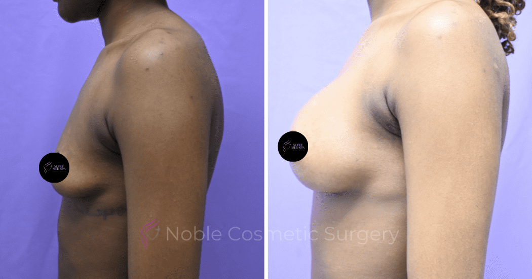 BREAST-AUGMENTATION--CASE-19521 | Before and After Breast Augmentation 4