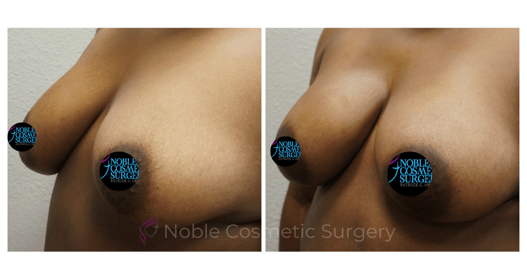 BREAST-AUGMENTATION-WITH-FAT-TRANSFER-CASE-00266 | Before and After Breast Augmentation