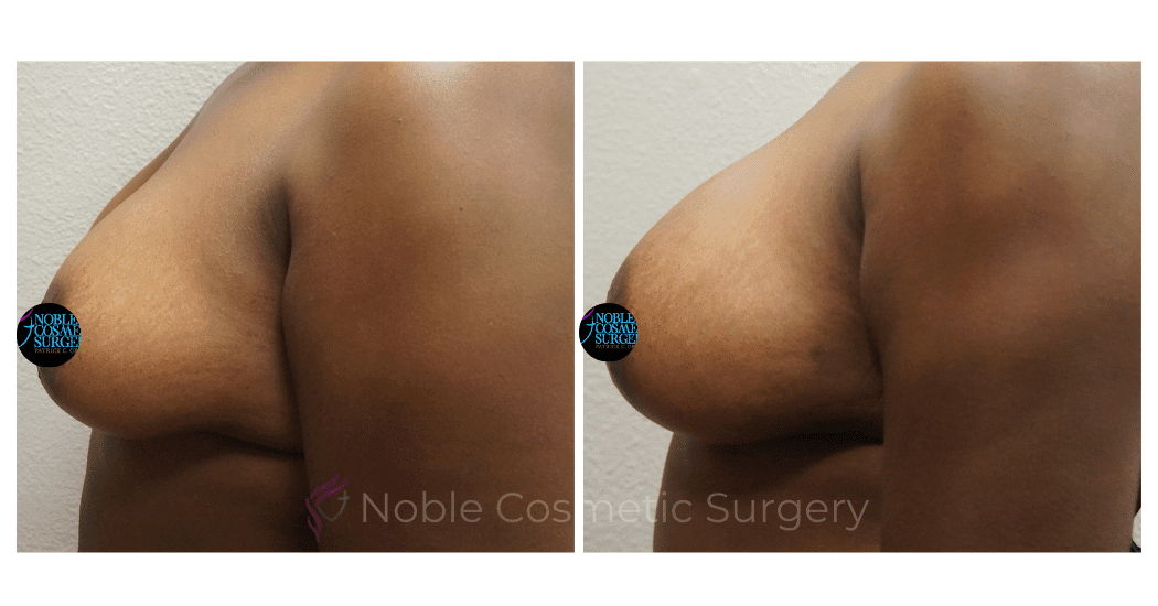 BREAST-AUGMENTATION-WITH-FAT-TRANSFER-CASE-00266 | Before and After Breast Augmentation 2