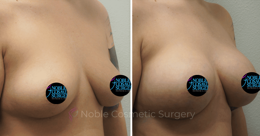 BREAST-AUGMENTATION-WITH-FAT-TRANSFER-CASE-00267 | Before and After Breast Augmentation 2