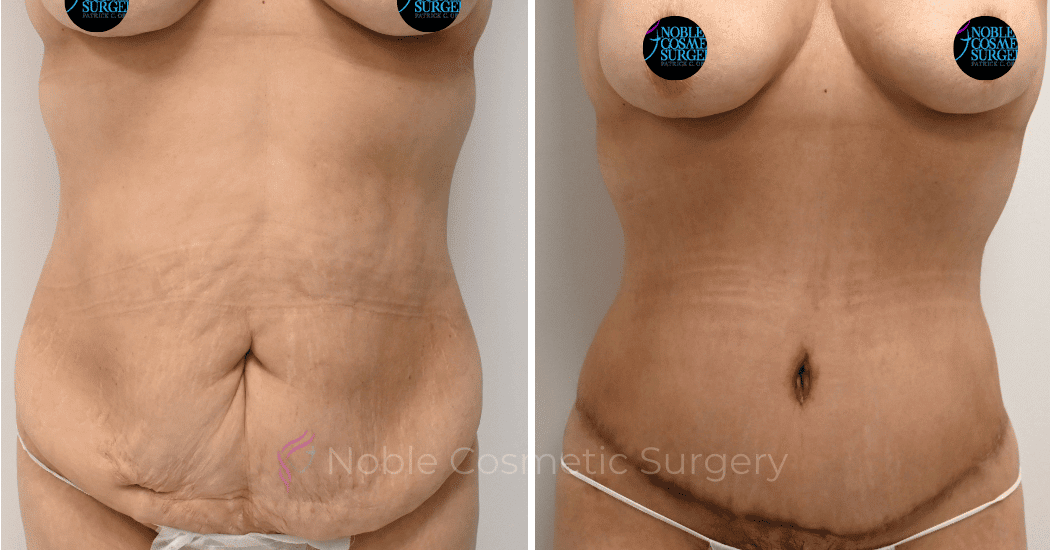 TUMMY-TUCK-CASE-00317 | Before and After Abdominoplasty 1