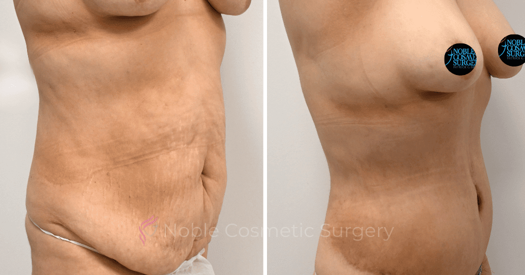 TUMMY-TUCK-CASE-00317 | Before and After Abdominoplasty 2