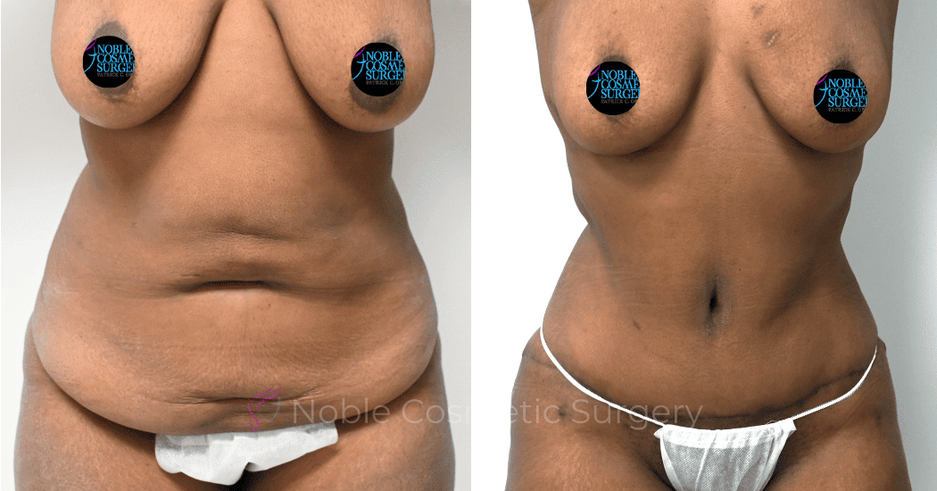 TUMMY-TUCK-CASE-00318 | Before and After Abdominoplasty 1