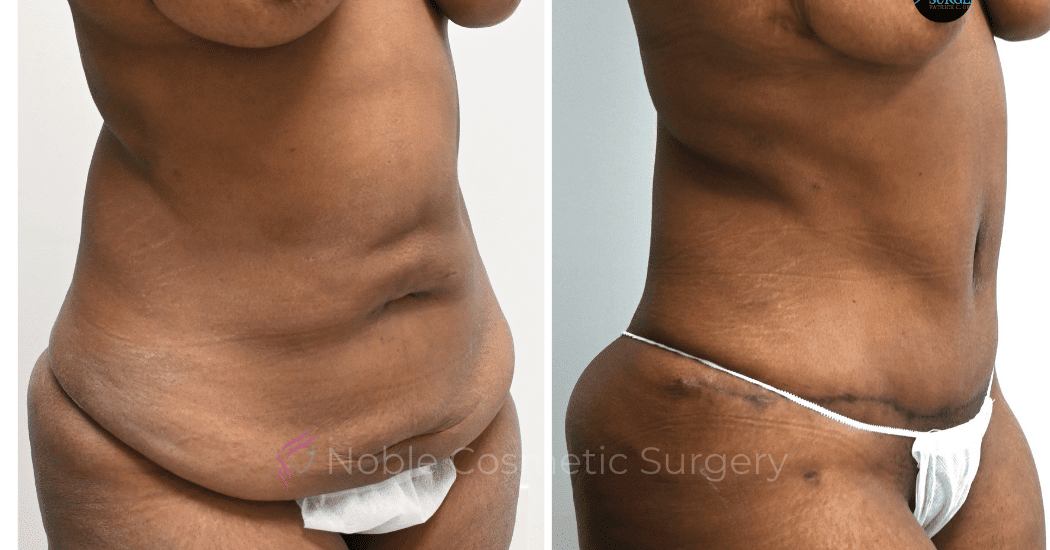 TUMMY-TUCK-CASE-00318 | Before and After Abdominoplasty 2