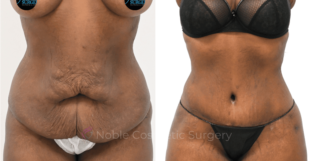 TUMMY-TUCK-CASE-00319 | Before and After Abdominoplasty 1