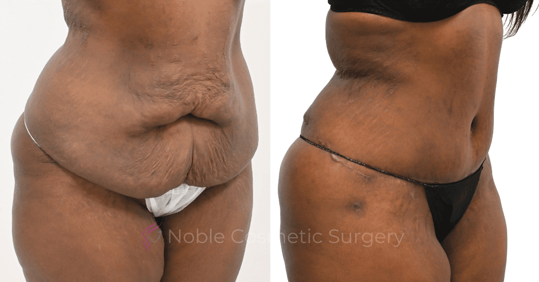 TUMMY-TUCK-CASE-00319 | Before and After Abdominoplasty 2