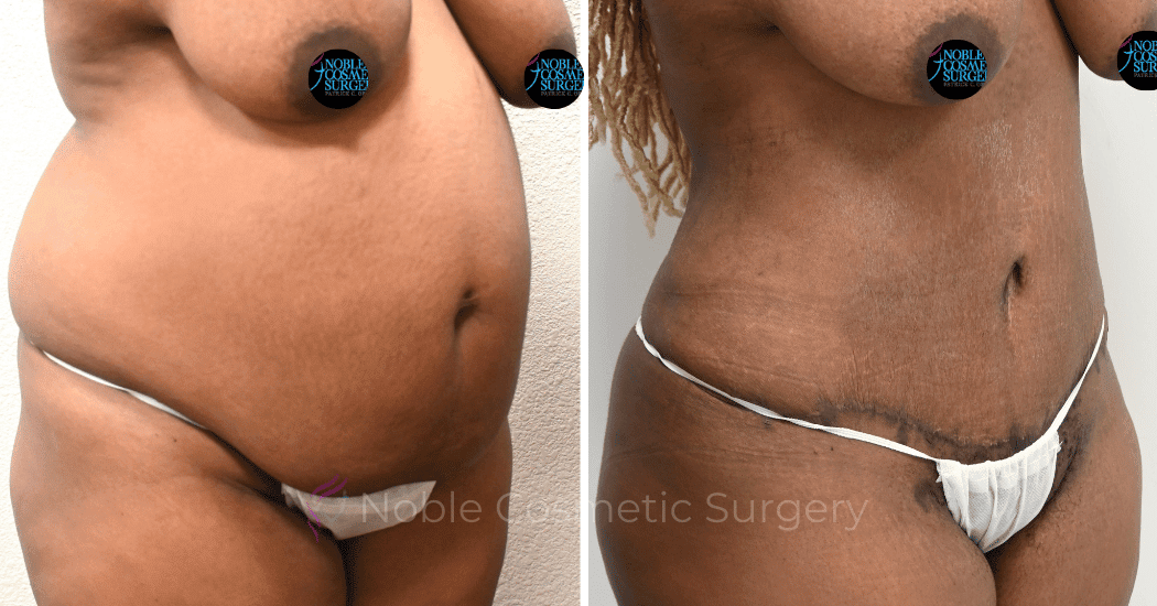 TUMMY-TUCK-CASE-00320 | Before and After Abdominoplasty 1