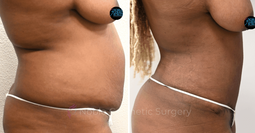 TUMMY-TUCK-CASE-00320 | Before and After Abdominoplasty 2