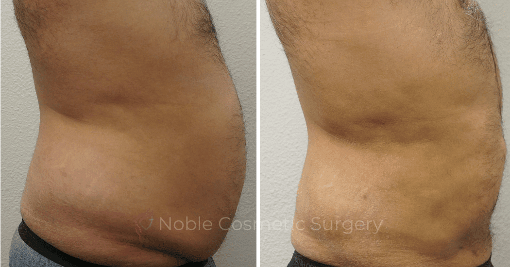 LIPOSUCTION-ABDOMEN-CASE-00600 | Before and After Male Liposuction
