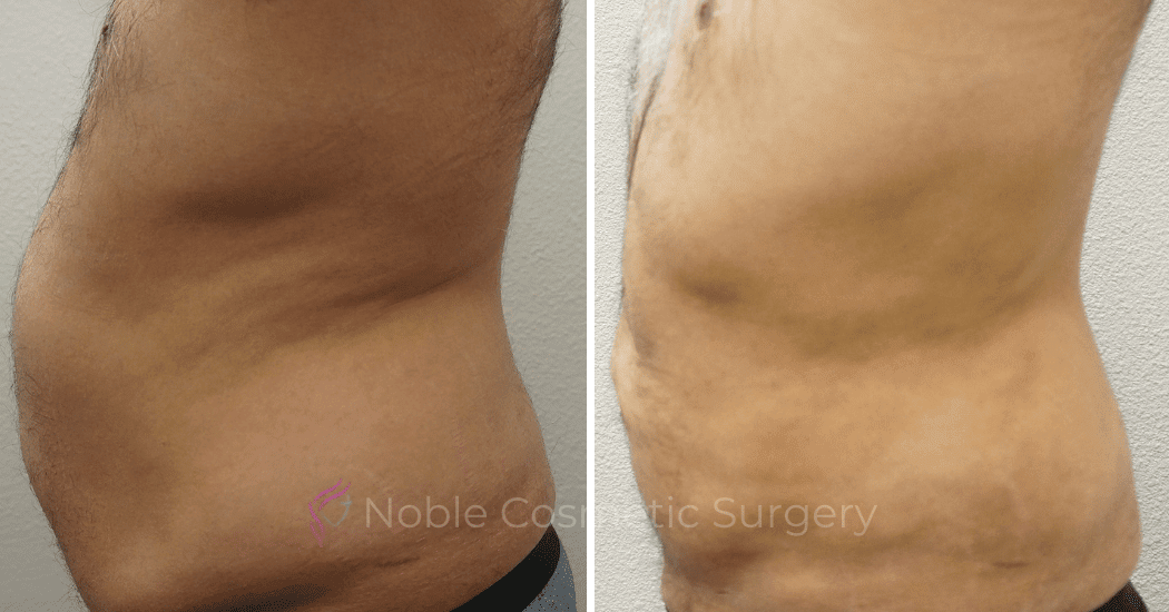LIPOSUCTION-ABDOMEN-CASE-00600 | Before and After Male Liposuction 2