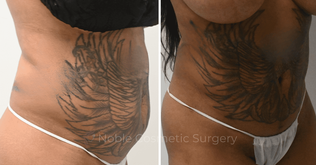 LIPOSUCTION-CASE-10243 | Before and After Liposuction