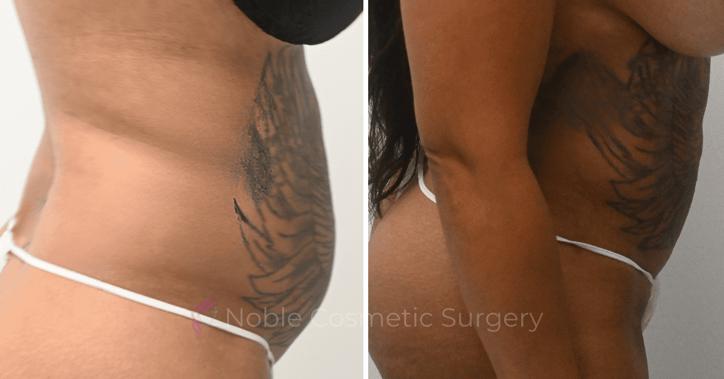 LIPOSUCTION-CASE-10243 | Before and After Liposuction 2