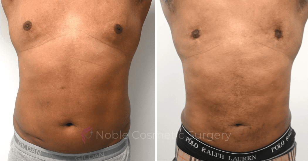GYNECOMASTIA-CASE-10270 | Before and After Gynecomastia