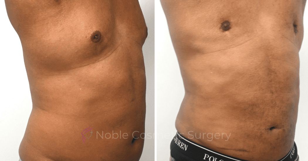 GYNECOMASTIA-CASE-10270 | Before and After Gynecomastia 2