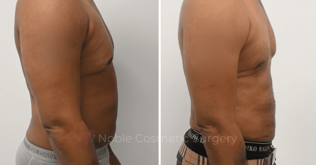 GYNECOMASTIA-CASE-10270 | Before and After Gynecomastia 3