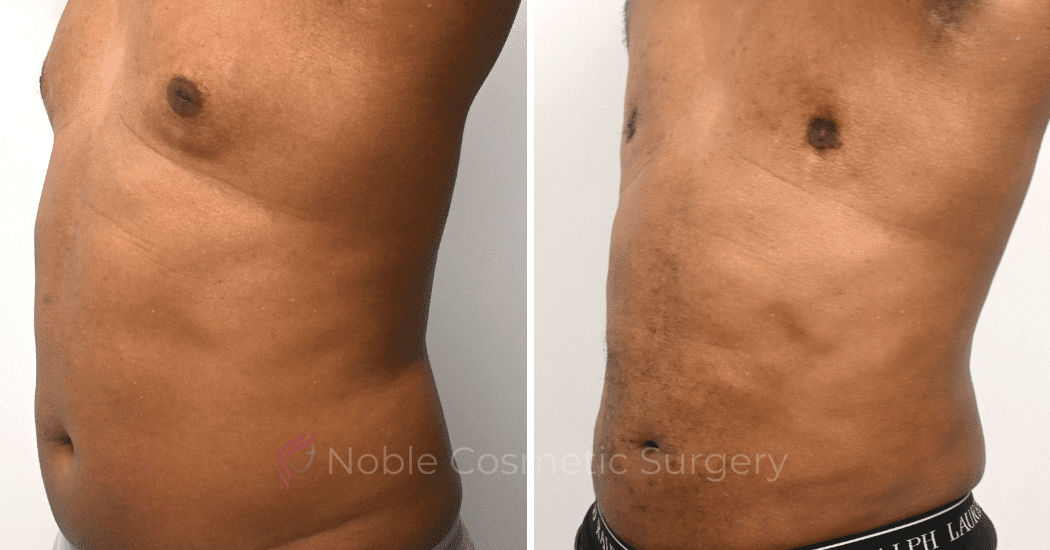 GYNECOMASTIA-CASE-10270 | Before and After Gynecomastia 4